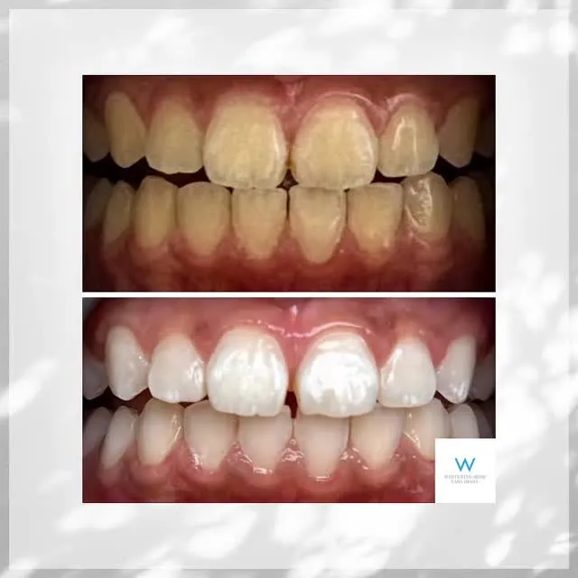 10代お客様のBefore after🦷✨