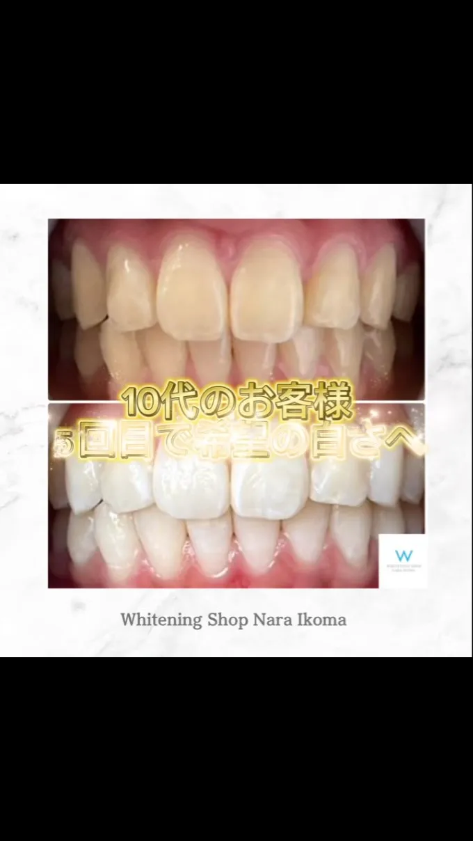 10代のお客様のBefore after🦷✨